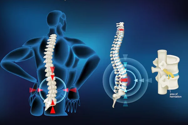 Slip Disc or Disc Prolapse