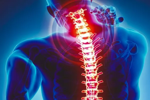 Cervical Spondylosis