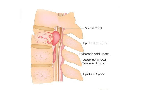 Spinal Tumours